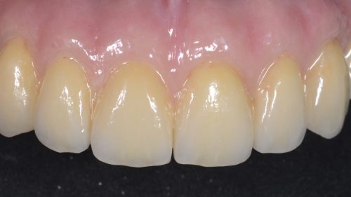 Tandtekniska-Laboratoriet-implantat-nr-3524
