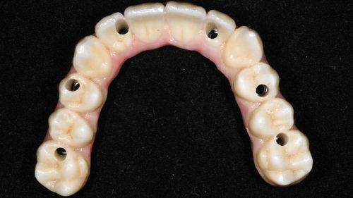 Tandtekniska-Laboratoriet-implantat-nr-8925