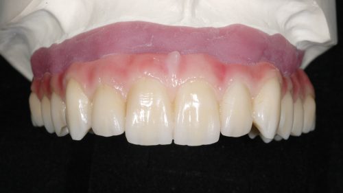 Tandtekniska-Laboratoriet-implantat-nr-8928