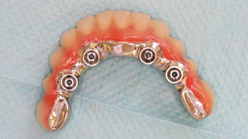 Tandtekniska-Laboratoriet-implantat-nr-britt-hard